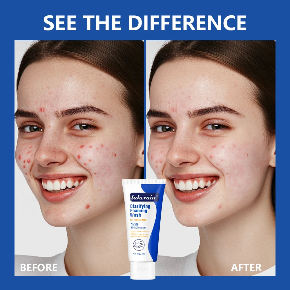 Benzoyl Peroxide 10% Acne Foaming Wash