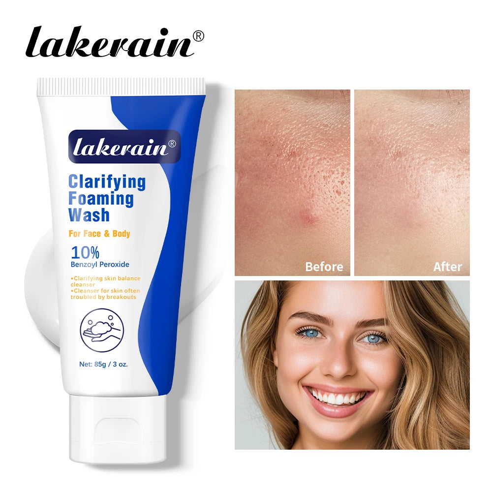 Benzoyl Peroxide 10% Acne Foaming Wash
